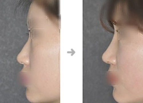 韩国鼻子整形厉害的医生盘点,半肋隆鼻选这位医生不踩雷