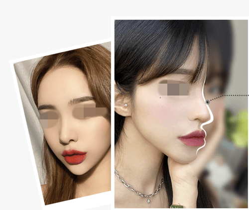 韩国整鼻子大概多少费用?分享几家韩国风格不同的隆鼻医院