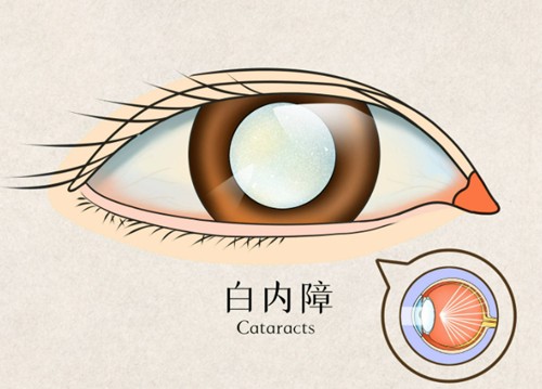 2025白内障手术费用表新版，单焦点人工晶体3000+/多焦点人工晶体10000+