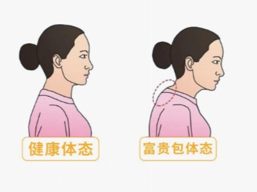 广州李方伟医生做富贵包怎么样？小创口、恢复快、价格也不贵