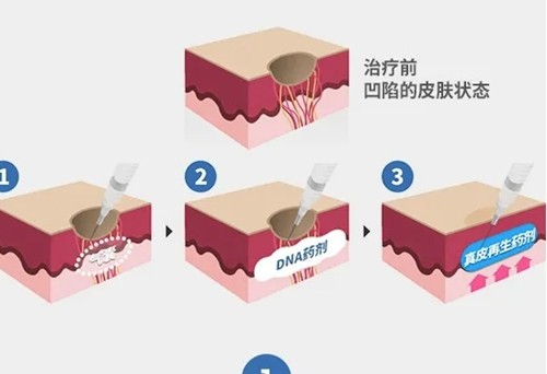 自体真皮再生术祛疤好吗？了解手术原理+价格+韩国口碑医院名单