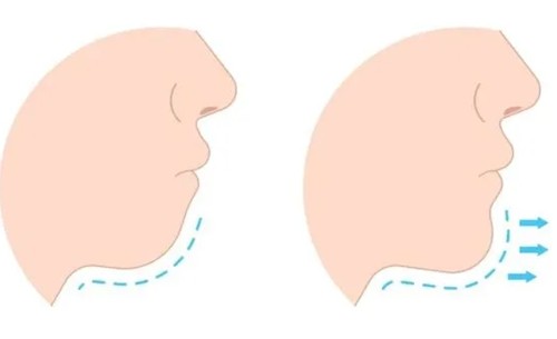 下巴后缩怎么矫正？正颌手术、牙齿矫正能改善下巴后缩吗？