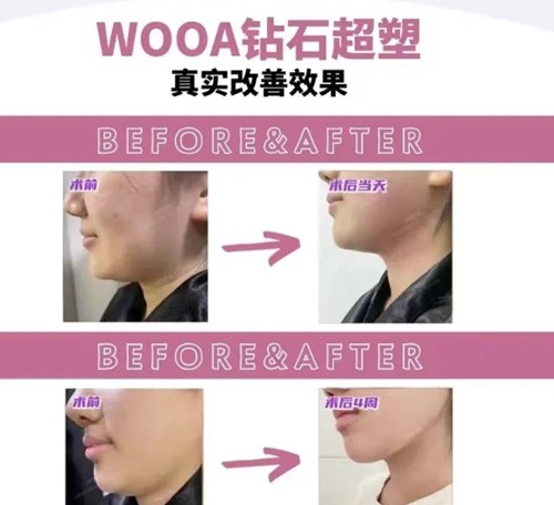 韩国inmode钻石超塑价格表一览，全脸做一次收费及口碑好的医院分享