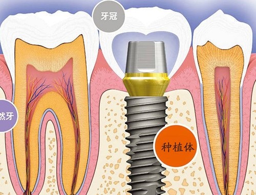 年轻人镶牙好还是种牙好？二十多岁种植牙的多吗？