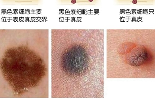 激光祛痣多久能恢复正常皮肤？点痣去医院挂哪个科价格贵吗？