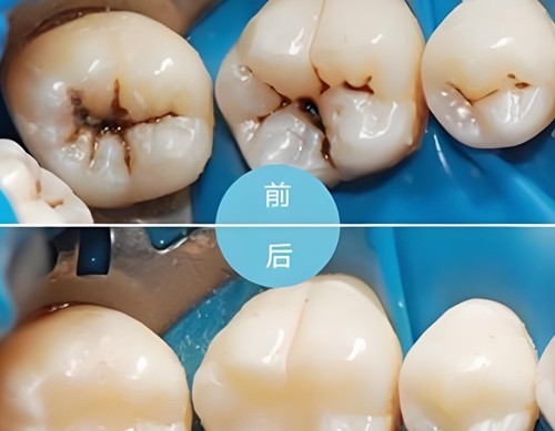 宜昌补牙价格多少钱一颗？树脂补牙费用及便宜又好的牙科医院公布
