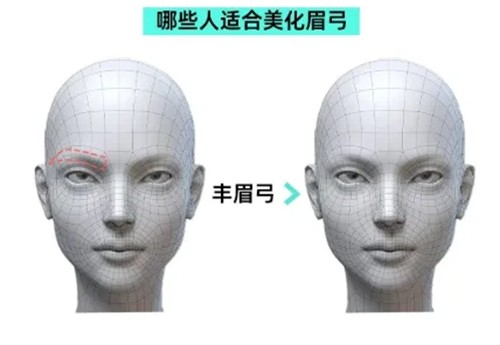 眉弓填充什么材料比较好一些？玻尿酸打眉弓会扩散吗？