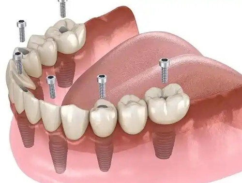 半口6颗种植牙图片大全，附半口种植价格表及适合人群