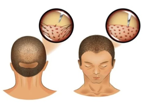 植发一平方厘米多少单位毛囊？头发种植2000单位价格贵吗？