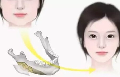 杭州下颌角手术做的好的医生及价格分享，高俊明、陈小平改脸型技术审美在线