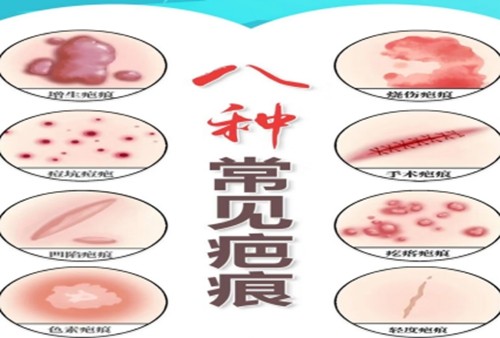 南通疤痕修复哪家医院好？激光祛疤看这三家技术不错附价格表
