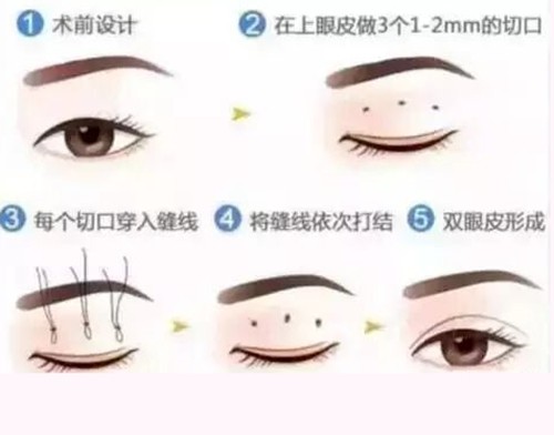 阳泉割双眼皮哪家正规美容医院好？格瑞、韩亚、迪美眼部整形技术优势拆解