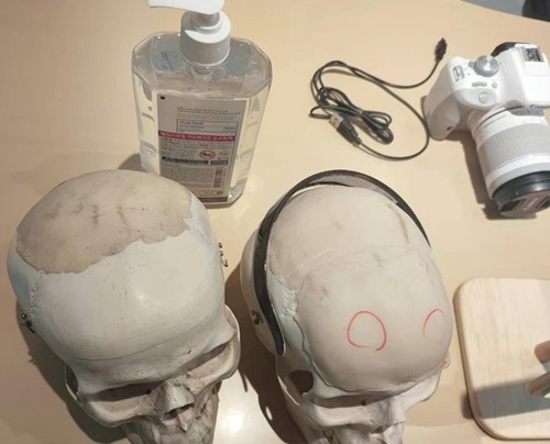 骨水泥垫额头和假体哪个好？赴韩整额头看这家医院口碑审美均在线