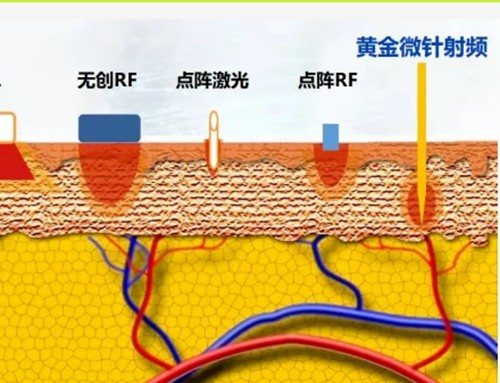 黄金微针有哪几种类型？分享赴韩做微针口碑好的皮肤科技术优势