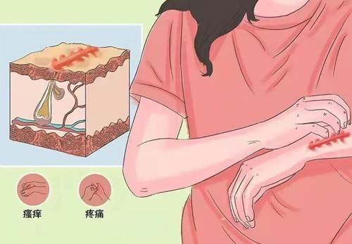 揭阳祛疤痕哪家医院好？烧烫伤、剖腹产疤痕修复看这几家人气高
