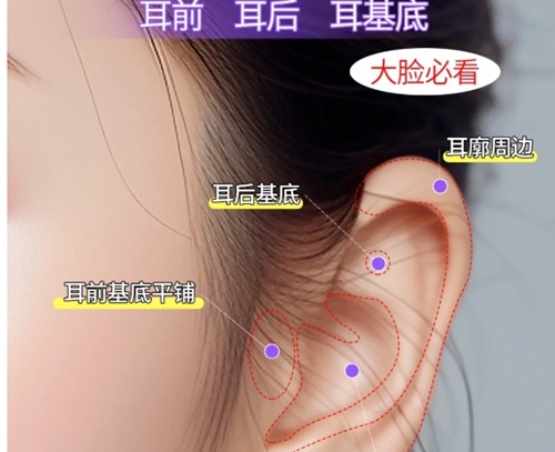 耳基底提升用玻尿酸好还是膨体？看韩国普罗菲耳、丽奥等医院注射人气高