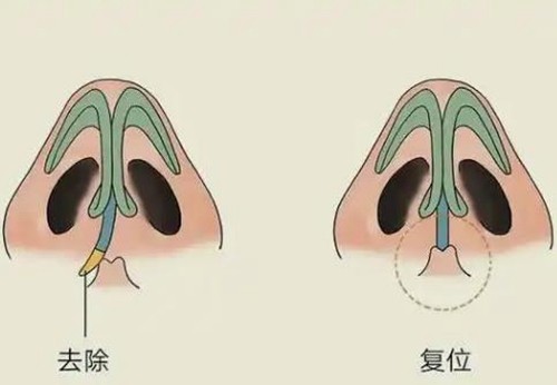 鼻子歪了矫正需要多少钱，做歪鼻矫正挂什么科？