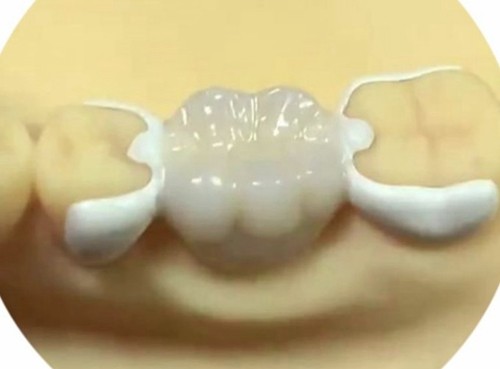 马里兰桥修复义齿怎么样?看了马里兰桥修复义齿特色+照片+牙友反馈才知道