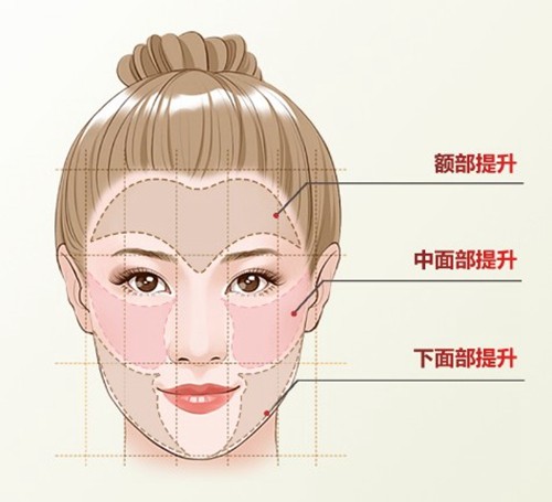 探究3d钻石网面部提升是什么价格几何，做3d织网提升面部手术脸会不会变宽