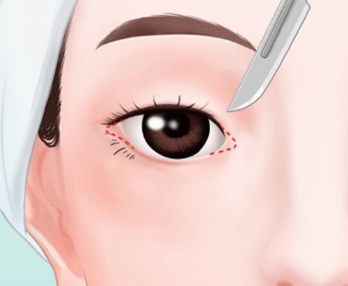 重庆内眼角修复医生排名大揭秘，患者信赖的口碑医生有胡金香&曹阳