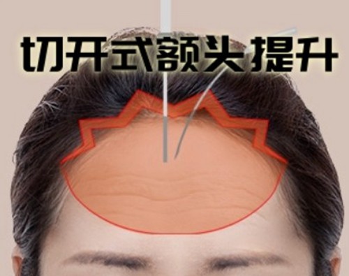 2026韩国额头提升术价格及口碑医院技术特色全解析，梦想、Faceplus、丽婷都有