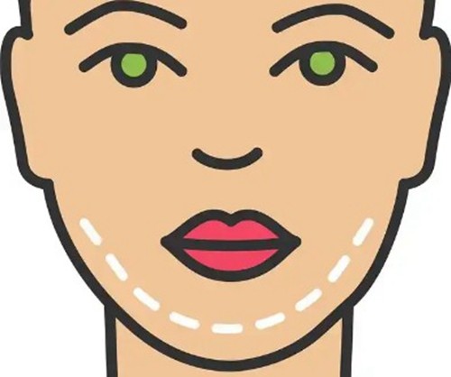 李功哲PEEK下巴订制好还是卢建好？李功哲数字化美学与骨面融合好不易移位