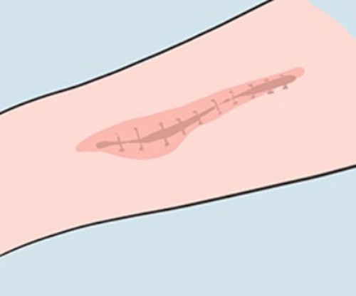 王连召plasma去疤vs武晓莉LCR治疗：疤痕修复技术深度对比及挂号全攻略