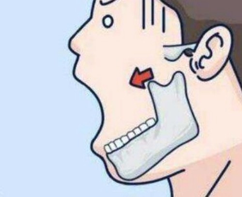 郑延清V-Line磨骨手术改脸型效果怎么样？长曲线截骨不垮脸收费5w起