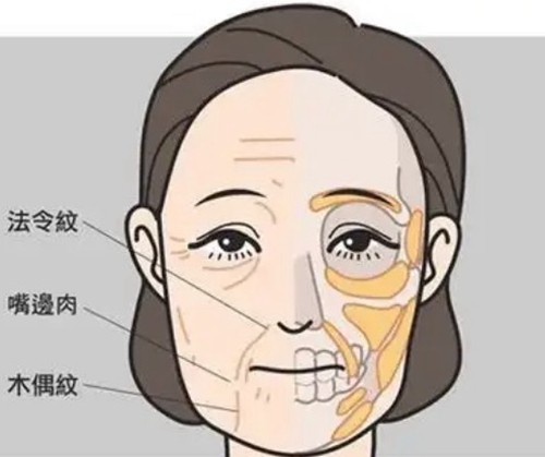 徐怀河SMAS深层提拉技术靠谱吗？内窥镜辅助做完无假面感费用35000起