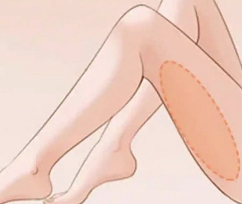 于世川医生大腿环吸做的好吗？深浅层联合柔性抽吸动态美学评估起价15000