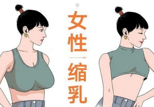 刁良亚医生做缩胸手术怎么样多少钱，做完后可以保持几年？