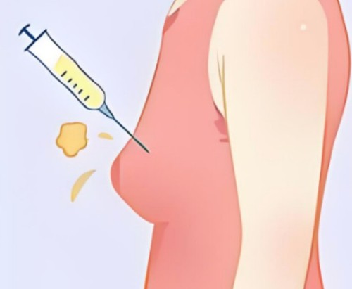 孙泽芳5C脂肪艺术丰胸需要填几次，怎么预约挂号？
