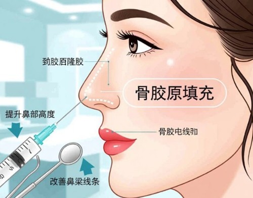天使针骨胶原隆鼻能维持多久？会栓塞吗？