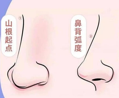 朱家旭医生做的鼻子怎么样？鼻尖四角支撑鼻头骨感美不会显得突兀