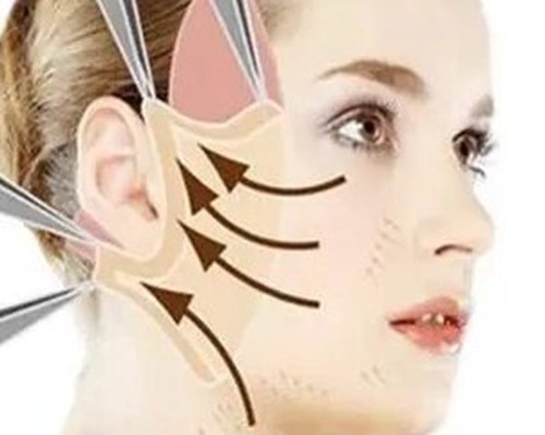 王志坚三点无痕逆龄术与4STCM面部年轻化有何区别？