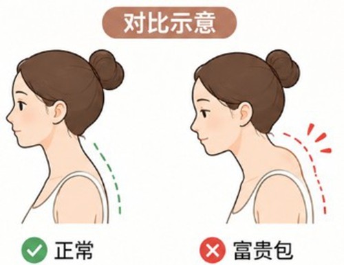 深圳富贵包微创手术价格表2026版，曹孟君/李益泽/周仁泽等名医技术去化率测评