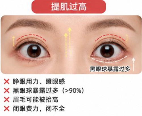 双眼皮提肌过高还能降下来吗？韩国眼修复热门医院特色深度解析