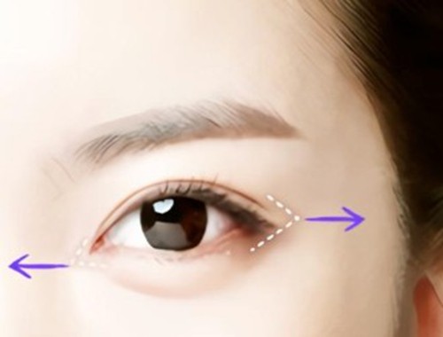 看了美杜莎双眼皮和普通双眼皮的区别，才知美杜莎双眼皮为啥那么贵？