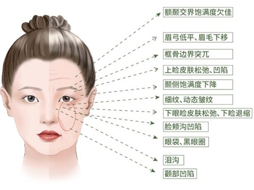 香港陳靖邦醫生玻尿酸輪廓固定做得好嗎？打造幼態臉一次需要多少錢？