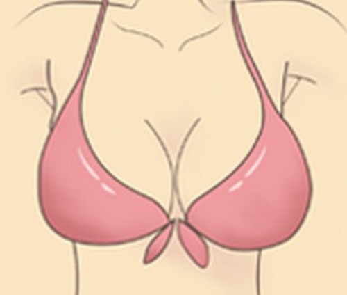 郭金才医生乳房再造术怎么样？显微操作扩张器 + 假体结合乳头和乳晕立体自然