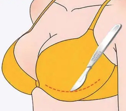 殷初阳乳房缩小好还是栗勇好？棒棒糖缩胸选殷初阳/改良重度下垂选栗勇