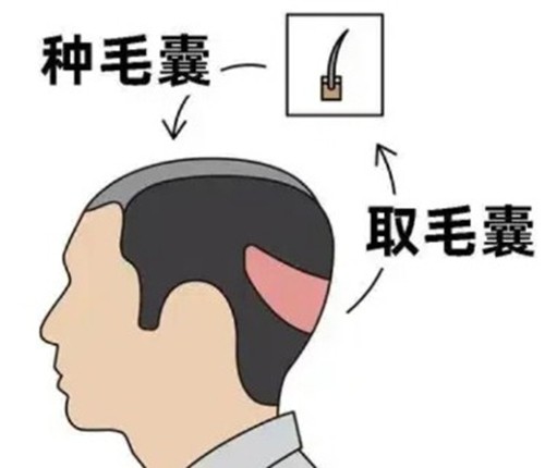 2026厦门植发1000个毛囊价格一览表，来看新生/碧莲盛/大麦微针哪家好？