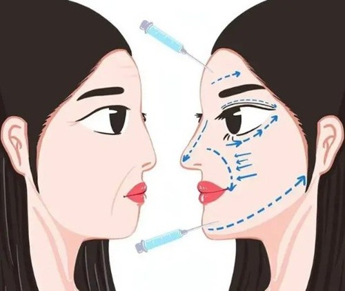 戴柳丽医生轮廓固定术口碑如何？美学设计分层分点注射做脸妈生感明显