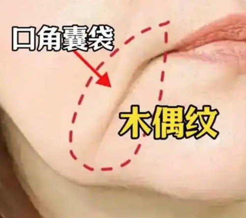 韩国做口周年轻化改善木偶纹要多少钱？首尔五大热门皮肤科抗衰特色解析