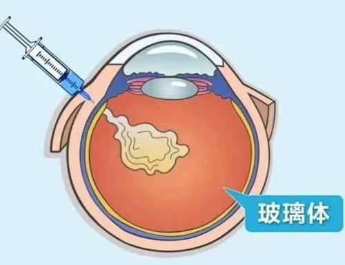 国内玻璃体手术医生测评：魏文斌、常青、彭晓燕等10大名医技术与特色解析