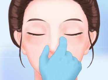 假体鼻子歪了找广州李希军可以修复吗？鼻整形深耕20余年技术口碑均不错
