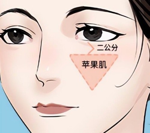蹇洪医生苹果肌复位是埋线手术吗？口内微创深层筋膜重塑是外科手术