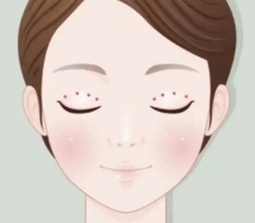 长沙何玮医生双眼皮埋线修复怎么样？显微技术精细剥离闭眼不全肉条皆可修