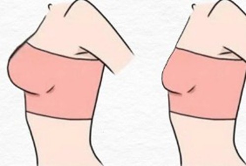 罗通贵医生的巨乳缩小技术好吗？缩胸注重功能与美学的平衡价格也不贵