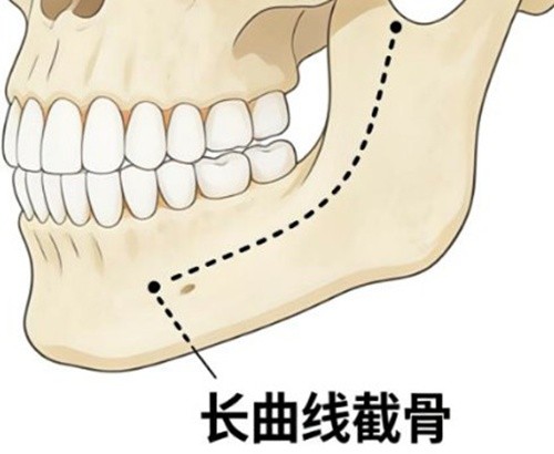 黄大勇磨骨在哪家医院坐诊？北京圣嘉荣微创剥离长曲线截骨做完不用担心垮脸